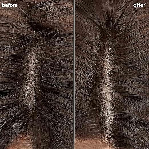 Biolage Professional Scalppure Anti-Dandruff Shampoo- Biolage Professional Scalppure Anti-Dandruff Shampoo - 200ml